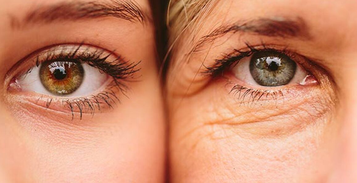 Silmaümbruse naha vananemise välisnähud kahel erinevas vanuses naisel