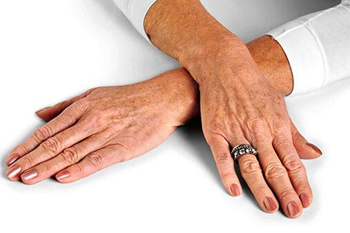 Käte nahk vanusega seotud muutustega, mis nõuavad noorendamistehnikate kasutamist