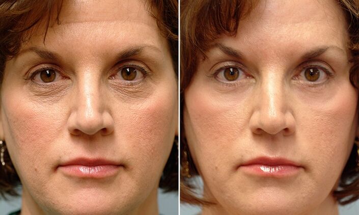 nägu enne ja pärast fraktsioneerivat laser noorendamist